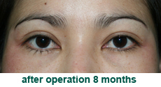 plastic-surgery-blepharoplasty